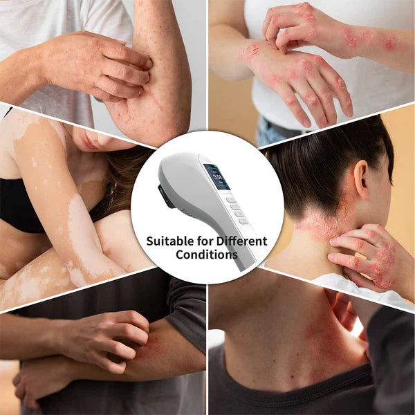 Kannettava UVB-vitiligo/psoriaasi-valoterapia-laite
