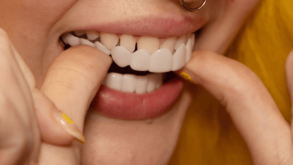 Instant Smile Transformation with Snap on Smile Veneers