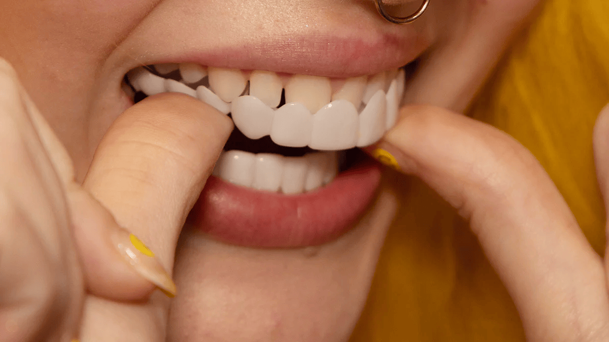 Instant Smile Transformation with Snap on Smile Veneers