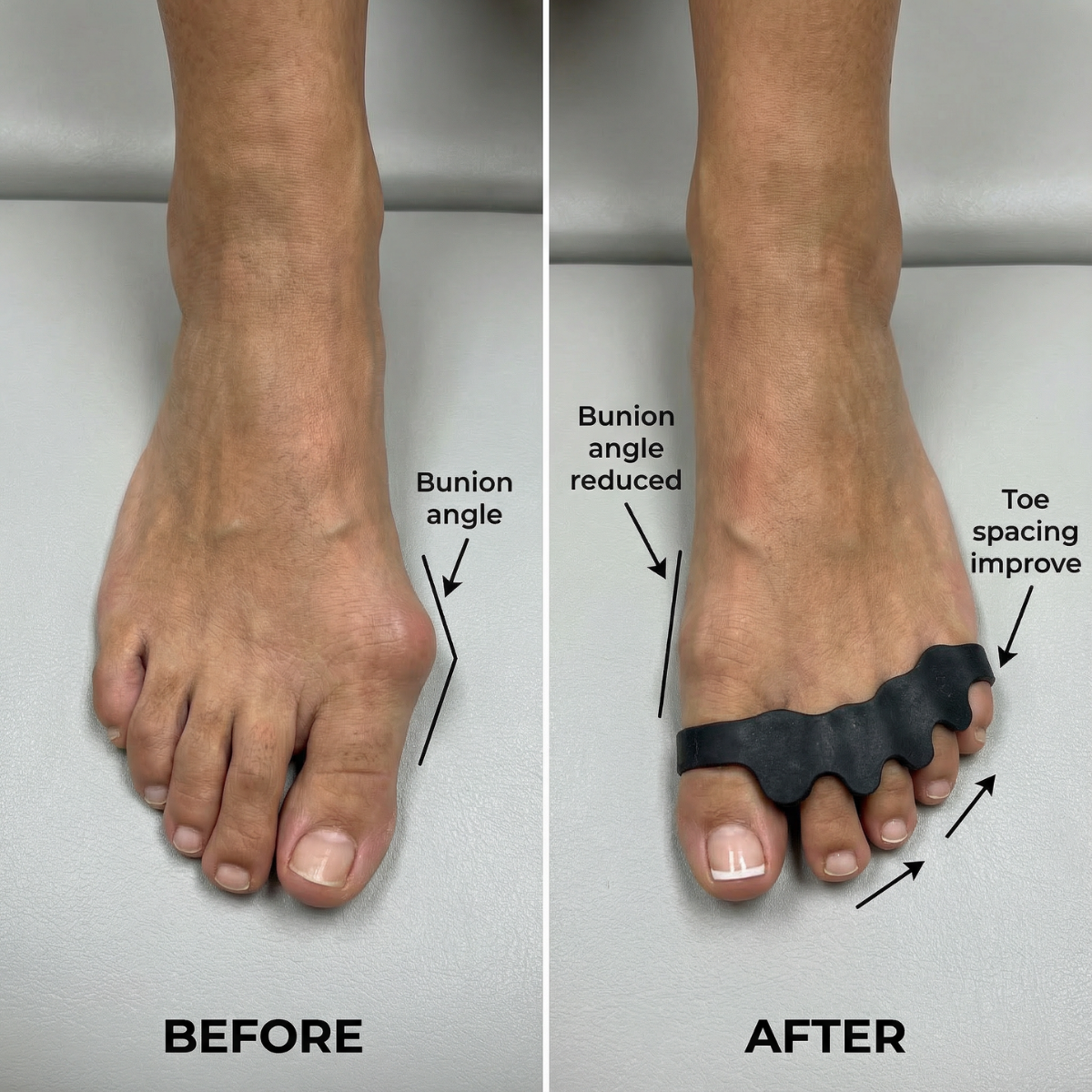 NovaStride Align Silicone Toe Spacers For Healthy Foot Alignment