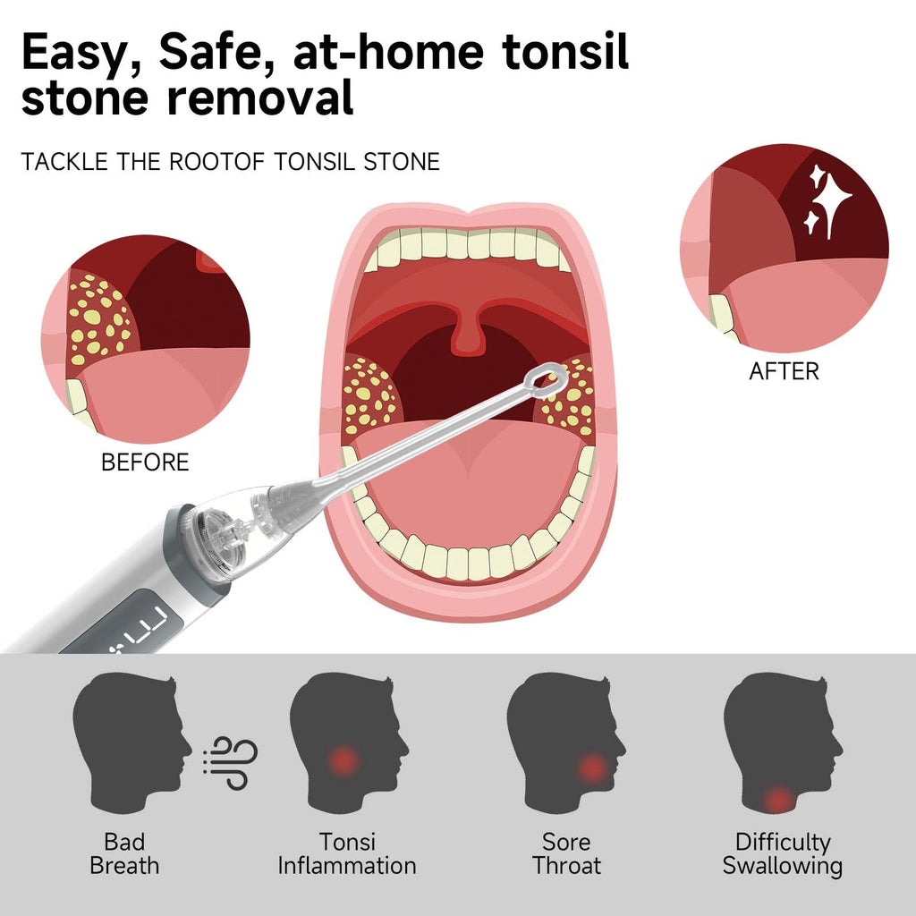 Home Use Kit For Removing Oral Debris Rinse Syringe Included