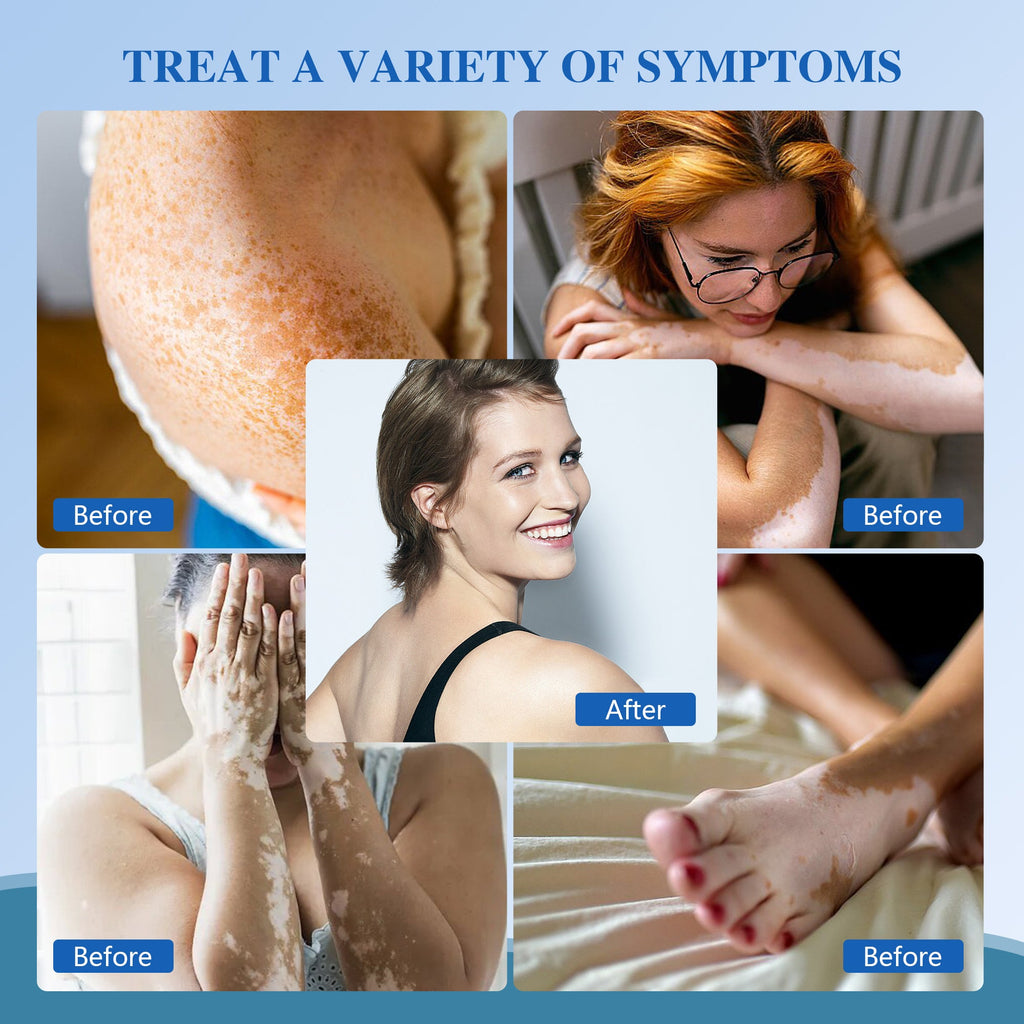 Kannettava UVB-vitiligo/psoriaasi-valoterapia-laite