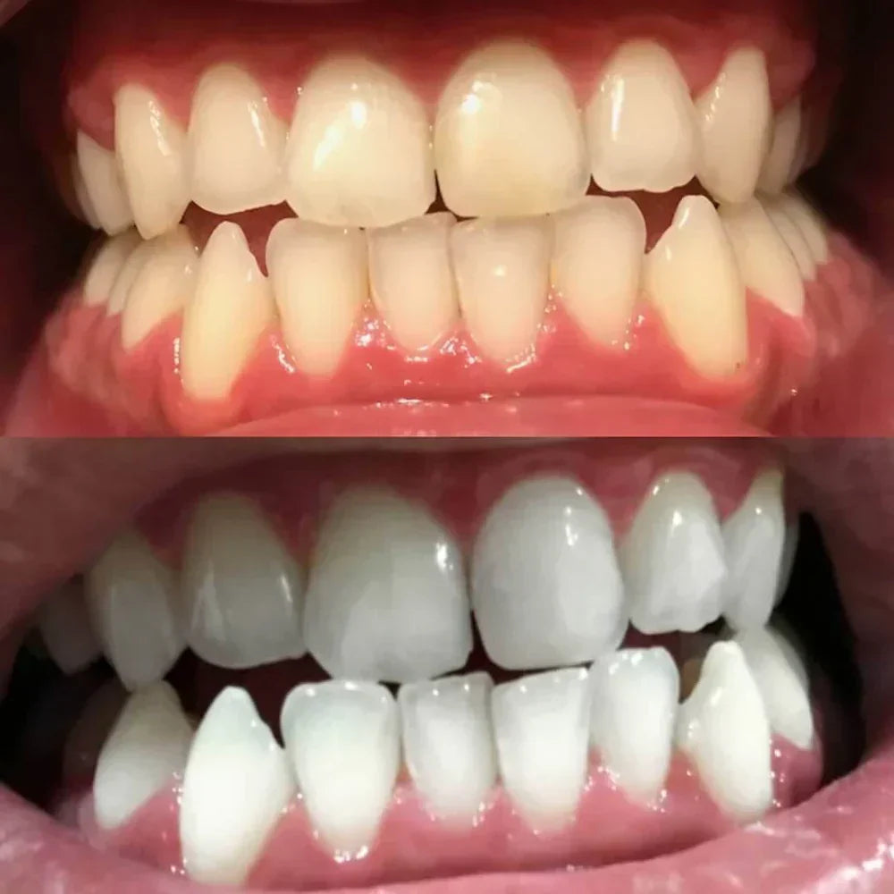 Stylo blanchisseur dentaire correcteur de couleur quotidien pour éclaircir les dents à la maison | Atiets