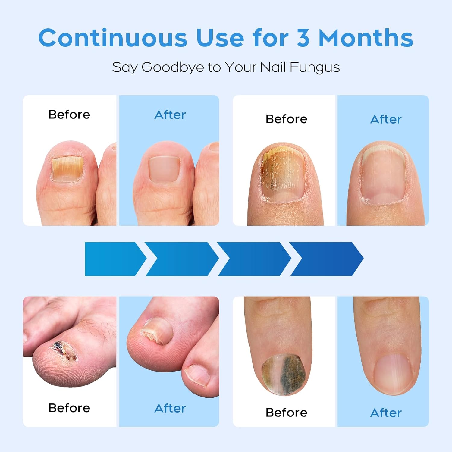 Nail Fungus Light for Multiple Toenails