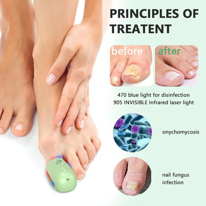 Toenail Fungus Laser Nail Care Device For Home Use