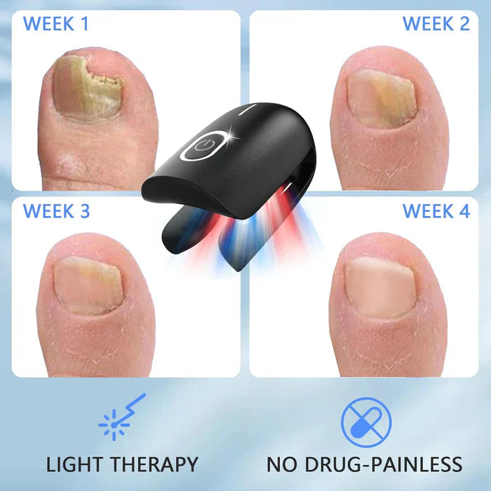 Toenail Fungus Laser Nail Care Device For Home Use