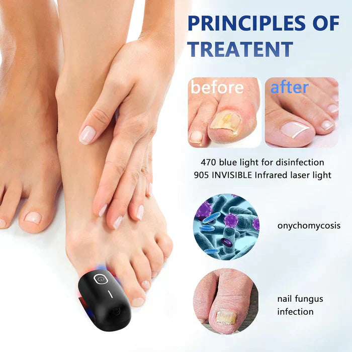 Toenail Fungus Laser Nail Care Device For Home Use