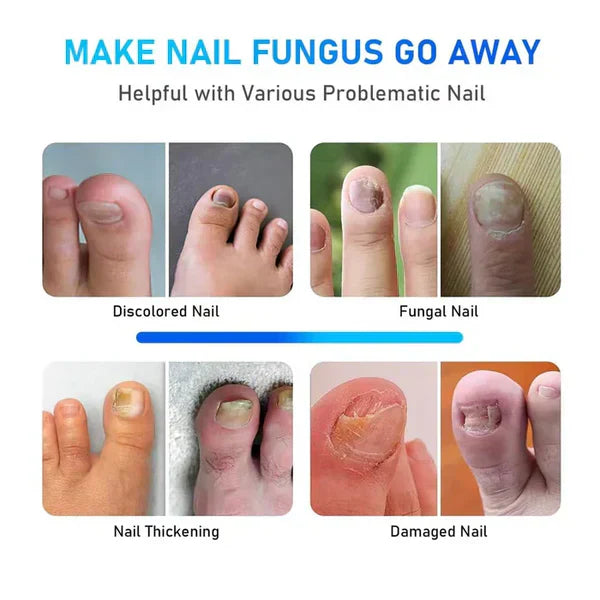 Dual-Wavelength Nail Laser Therapy Device For Nails On Hands And Feet