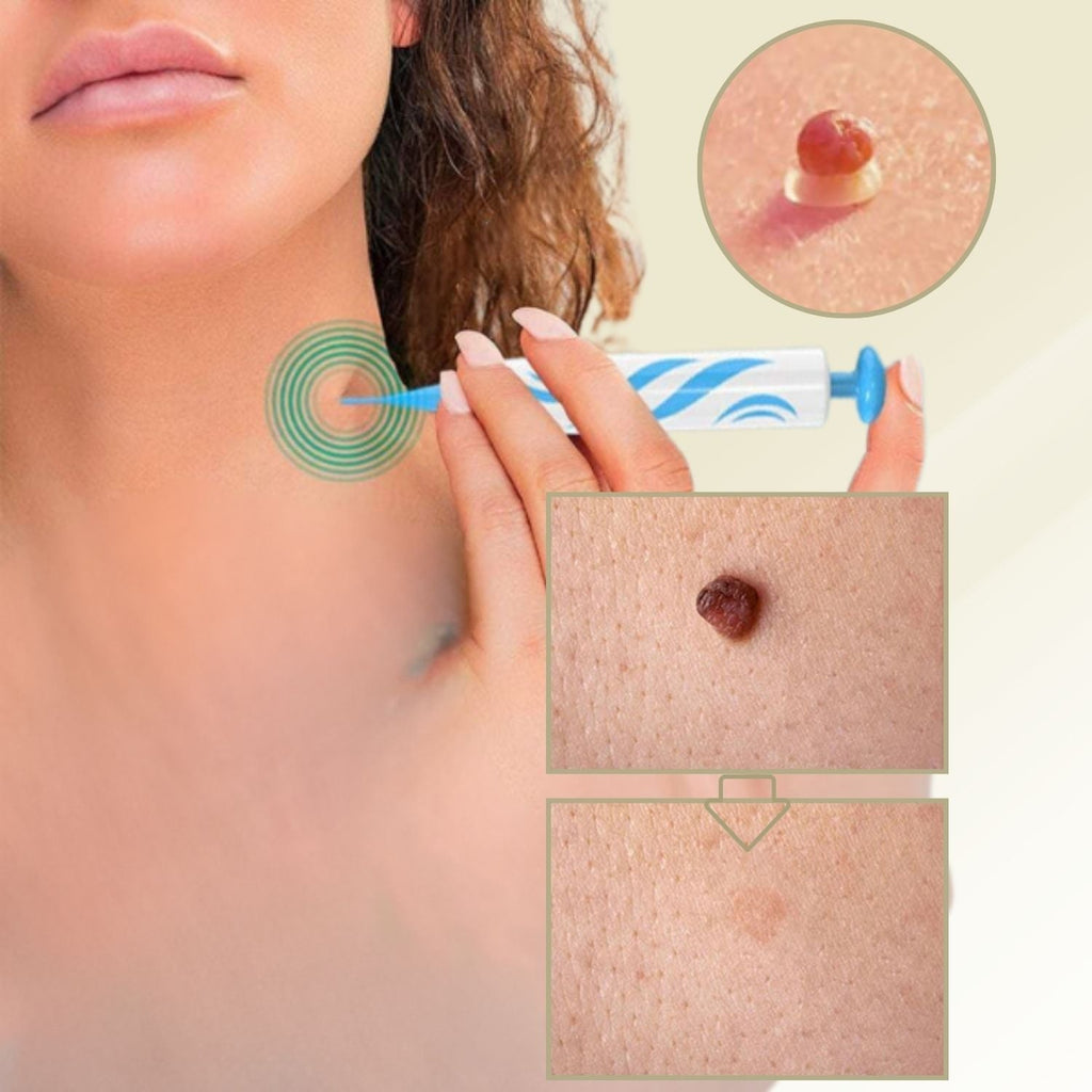 DermaLinx At-Home Skin Blemish Care Kit For Quick Home Use