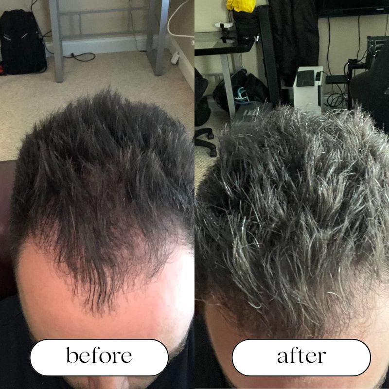 Red Light Cap For Hair Growth And Scalp Health At Home