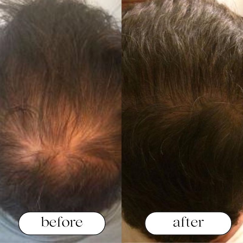 Red Light Cap For Hair Growth And Scalp Health At Home