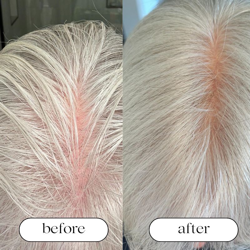 Red Light Cap For Hair Growth And Scalp Health At Home