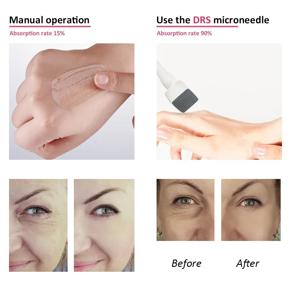 NovaDerm 140-igłowy derma roller z regulowanym pokrętłem do pielęgnacji skóry w domu