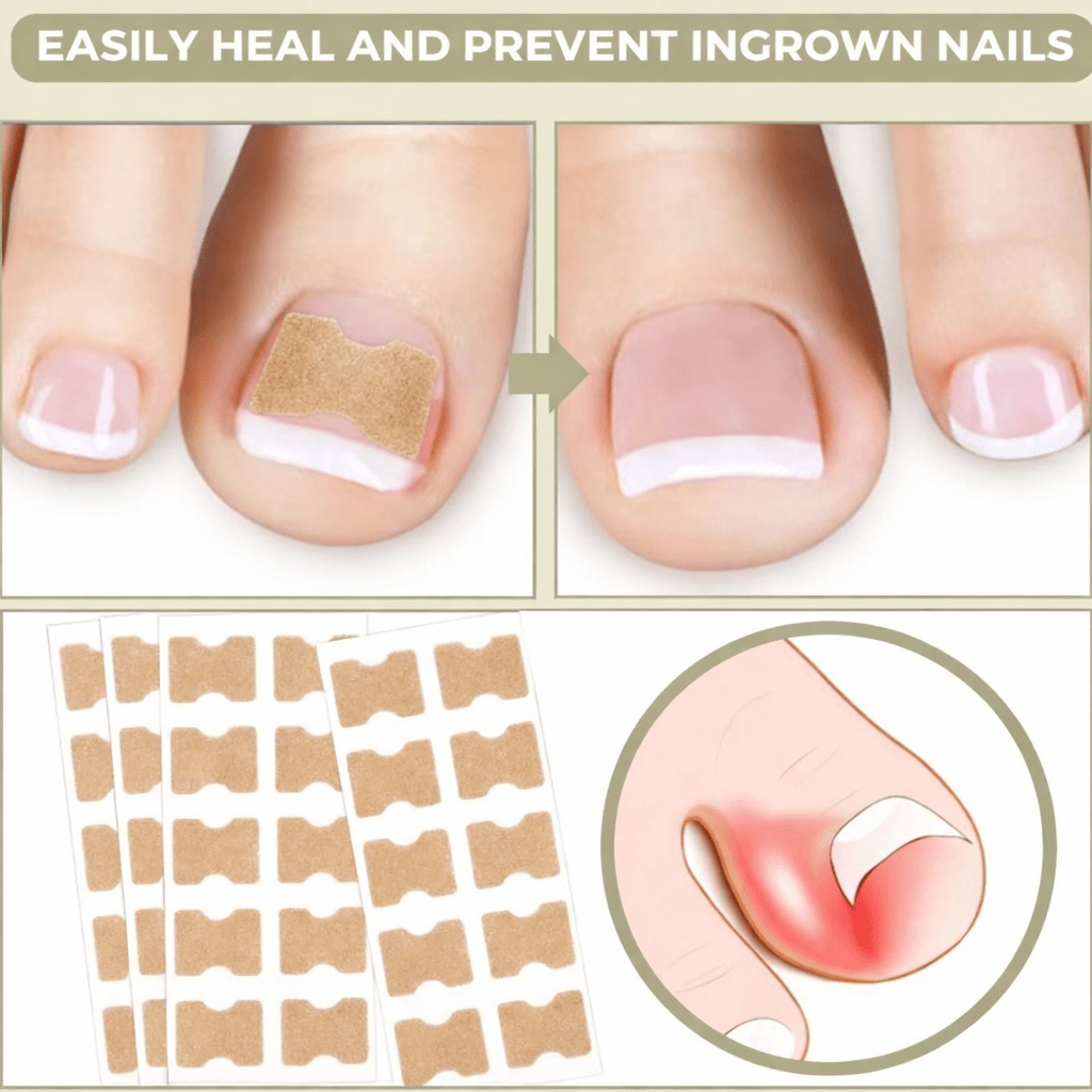 Tiras Suaves NailEase para Alinear Uñas Encarnadas o Deformadas
