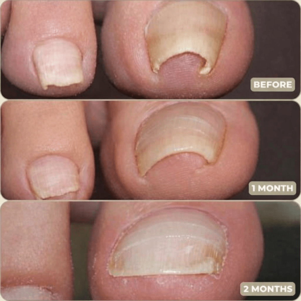 Tiras Suaves NailEase para Alinear Uñas Encarnadas o Deformadas