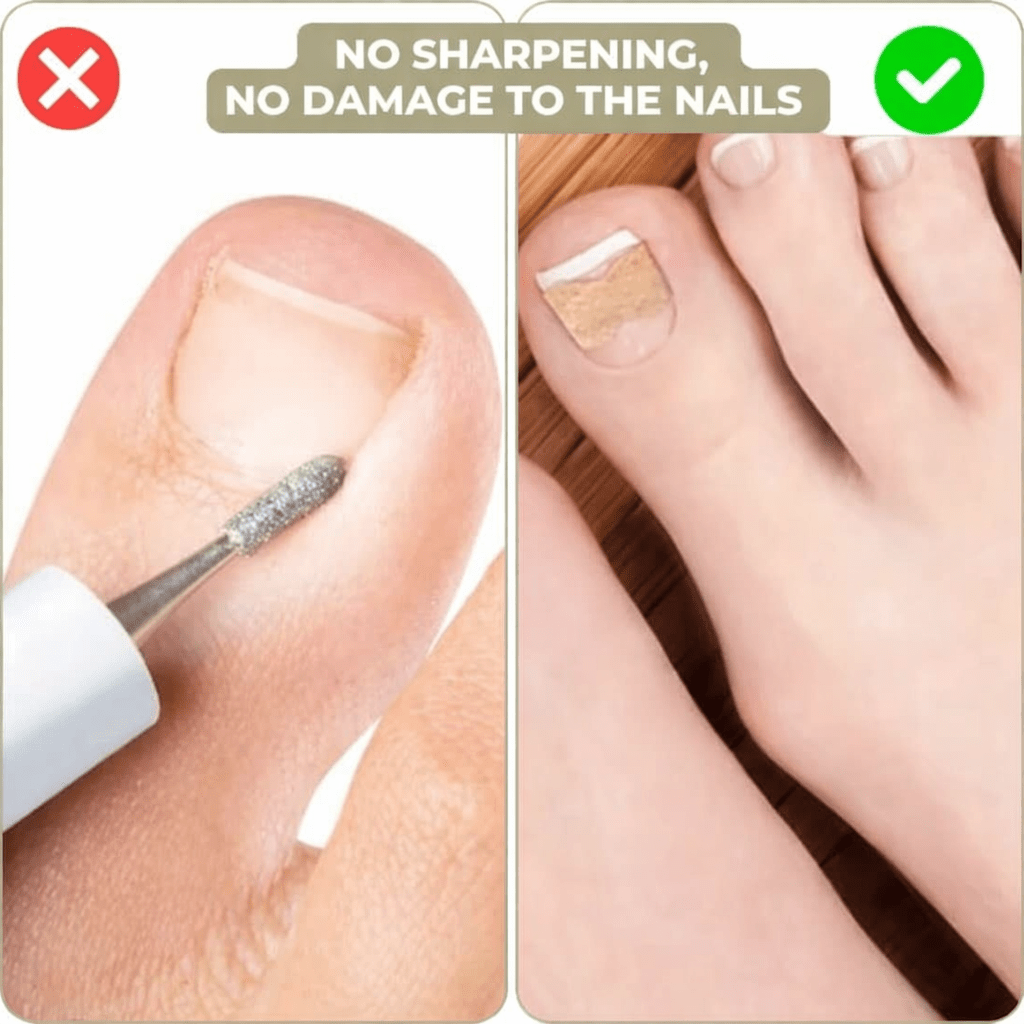 Tiras Suaves NailEase para Alinear Uñas Encarnadas o Deformadas