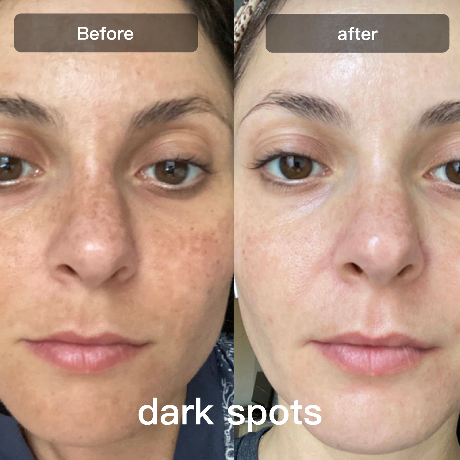 Face And Body Skin Care With Multicolor LED Light For Smoothing And Texture