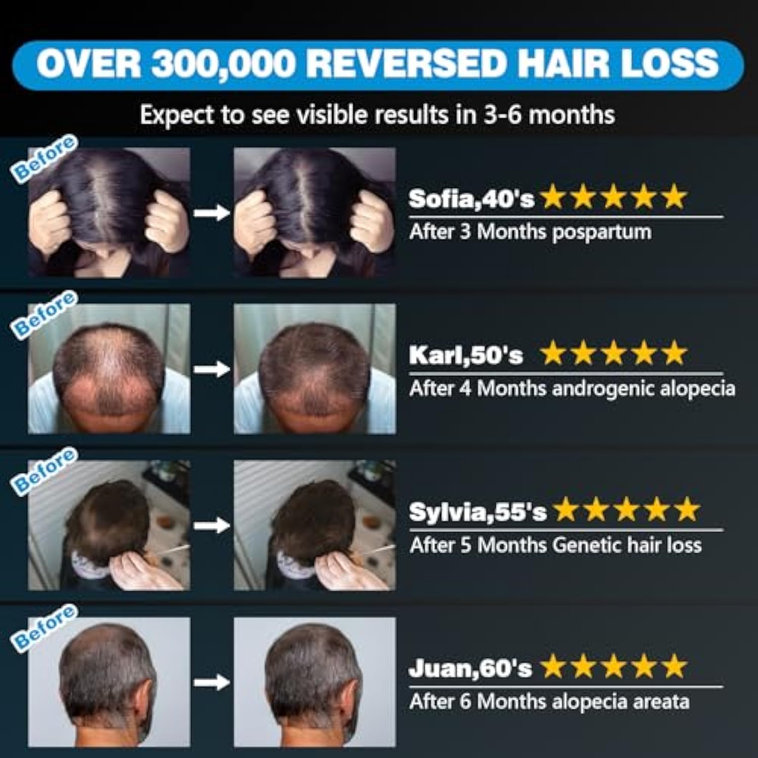 1.0 Pro Edition Laser Cap For Scalp Use Daily Wear